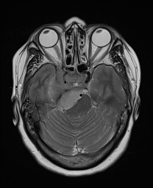 File:Cavernous sinus meningioma (Radiopaedia 63682-72367 Axial T2 8).jpg