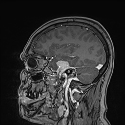 Cavernous sinus meningioma (Radiopaedia 63682-72367 Sagittal T1 C+ 60).jpg