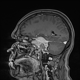 Cavernous sinus meningioma (Radiopaedia 63682-72367 Sagittal T1 C+ 71).jpg