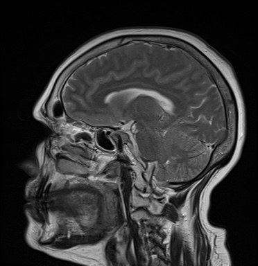 File:Cavernous sinus meningioma (Radiopaedia 63682-72367 Sagittal T2 12).jpg
