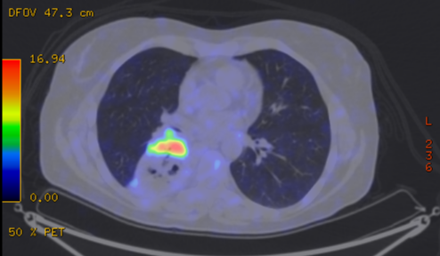 File:Cavitating lung mass - squamous cell carcinoma (Radiopaedia 48047-52853 A 51).png