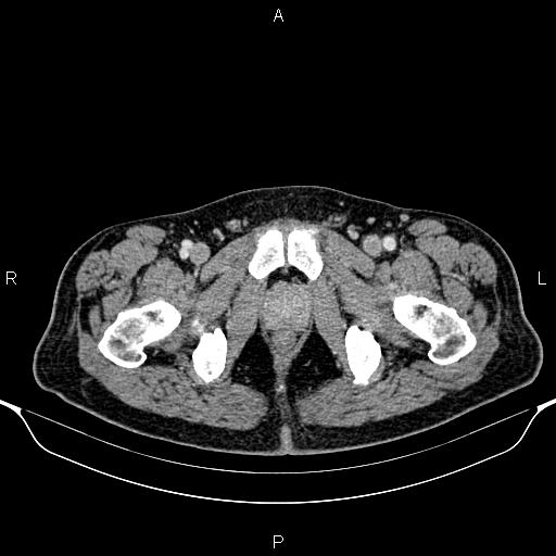Cecal adenocarcinoma (Radiopaedia 85324-100916 B 102).jpg