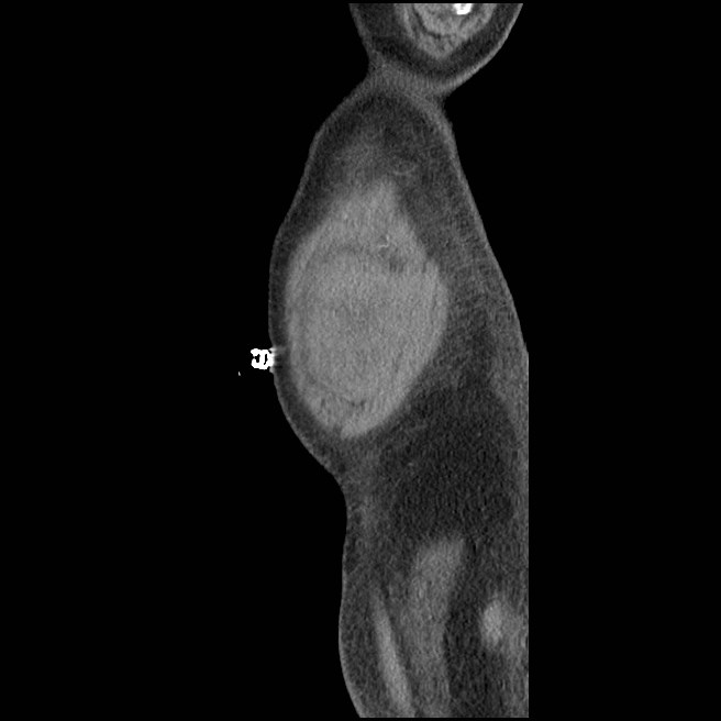 Cecal bascule (Radiopaedia 61096-68973 C 1).jpg