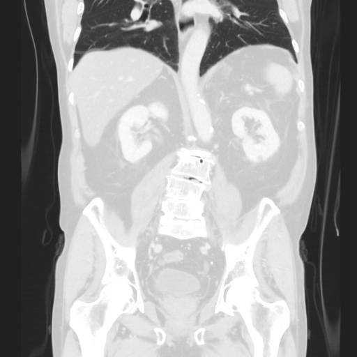 Cecal volvulus (Radiopaedia 75378-86620 Coronal lung window 89).jpg