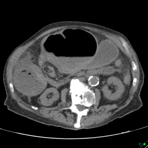 Cecal volvulus - atypical (Radiopaedia 21637-21588 non-contrast 31).jpg