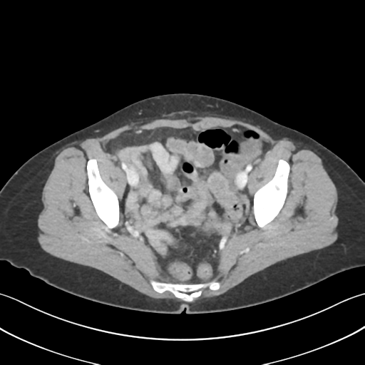 Cecum hernia through the foramen of Winslow (Radiopaedia 46634-51112 A 62).png