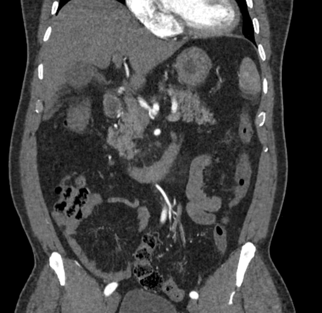 Celiac artery dissection (Radiopaedia 52194-58080 C 35).jpg