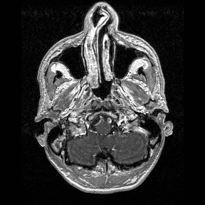 Central-variant posterior reversible encephalopathy syndrome (PRES) (Radiopaedia 43880-47358 Axial T1 C+ 10).jpg