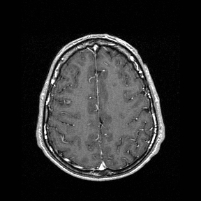 File:Central-variant posterior reversible encephalopathy syndrome (PRES) (Radiopaedia 43880-47358 Axial T1 C+ 129).jpg