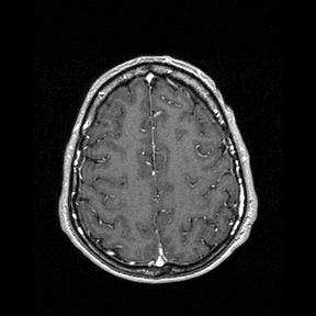 File:Central-variant posterior reversible encephalopathy syndrome (PRES) (Radiopaedia 43880-47358 Axial T1 C+ 132).jpg