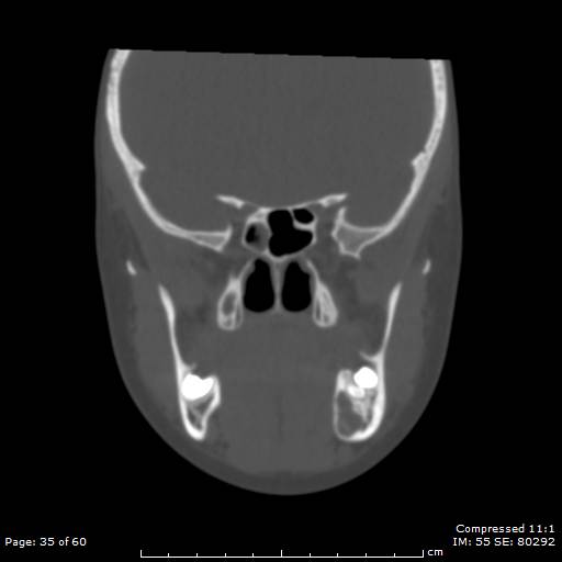 Central giant cell granuloma (Radiopaedia 45612-49754 Coronal bone window 35).jpg