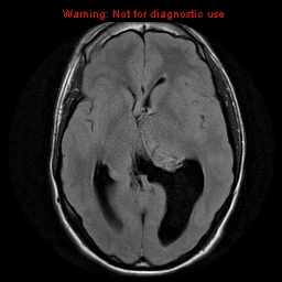 File:Central neurocytoma (Radiopaedia 13188-13206 Axial FLAIR 1).jpg