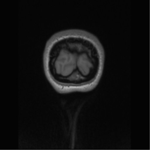 Central neurocytoma (Radiopaedia 37664-39557 Coronal T1 4).png
