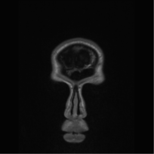 Central neurocytoma (Radiopaedia 37664-39557 Coronal T1 87).png