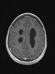 Central neurocytoma (Radiopaedia 56690-63469 Axial T1 C+ 125).jpg