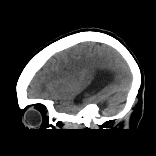 File:Central neurocytoma (Radiopaedia 65317-74346 C 39).png