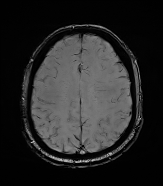 File:Central neurocytoma (Radiopaedia 71068-81303 Axial SWI 46).jpg