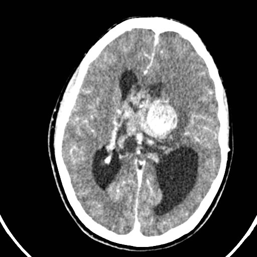 Central neurocytoma (Radiopaedia 84497-99871 B 25).jpg
