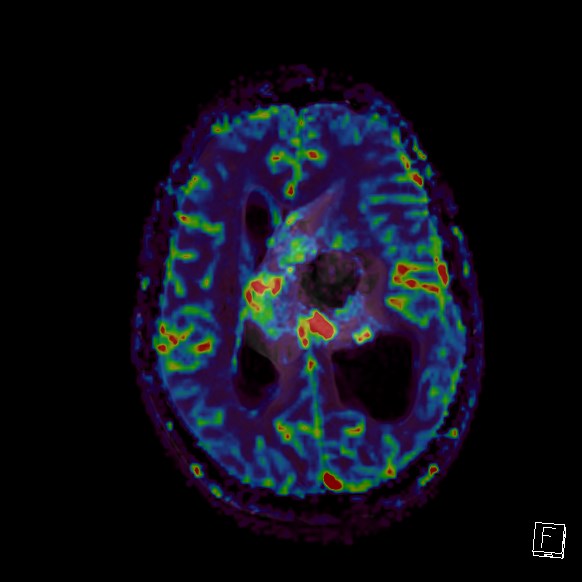 Central neurocytoma (Radiopaedia 84497-99872 Axial Perfusion 129).jpg