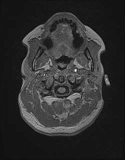 Central neurocytoma (Radiopaedia 84497-99872 Axial T1 18).jpg