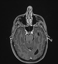 Central neurocytoma (Radiopaedia 84497-99872 Axial T1 C+ 52).jpg