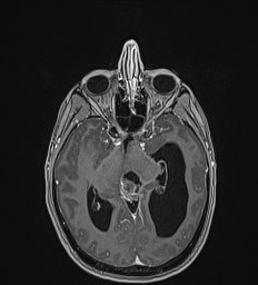 Central neurocytoma (Radiopaedia 84497-99872 Axial T1 C+ 66).jpg