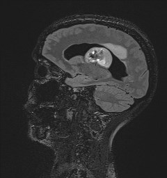 Central neurocytoma (Radiopaedia 84497-99872 Sagittal Flair + Gd 60).jpg