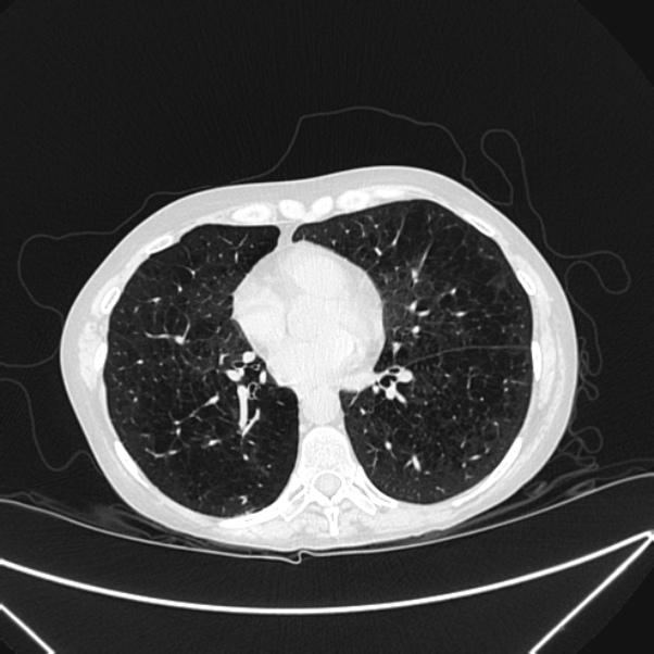 Centrilobular pulmonary emphysema (Radiopaedia 24495-24789 Axial lung window 58).jpg