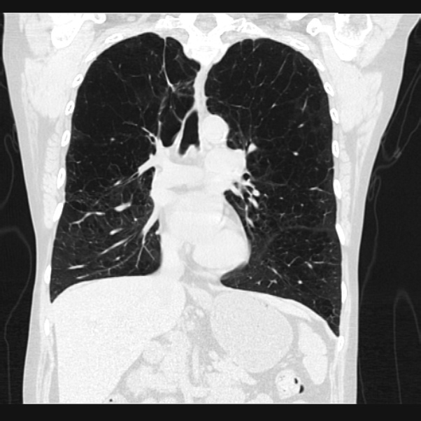 Centrilobular pulmonary emphysema (Radiopaedia 24495-24789 Coronal lung window 36).jpg