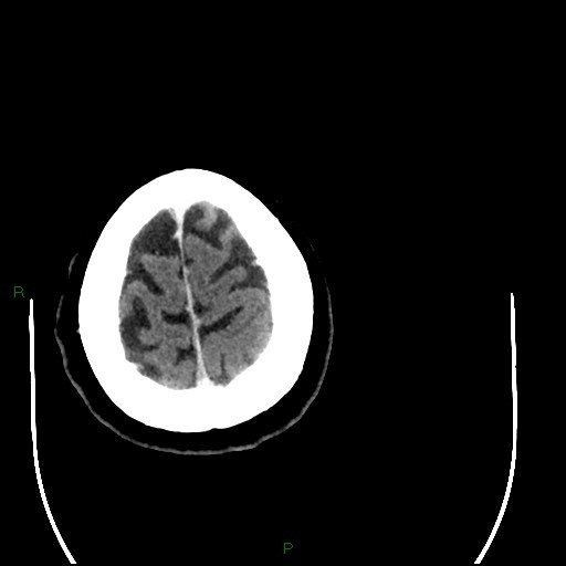Cerebellar abscess (Radiopaedia 78135-90671 Axial C+ delayed 100).jpg