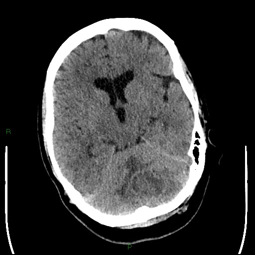 Cerebellar abscess (Radiopaedia 78135-90671 Axial non-contrast 46).jpg