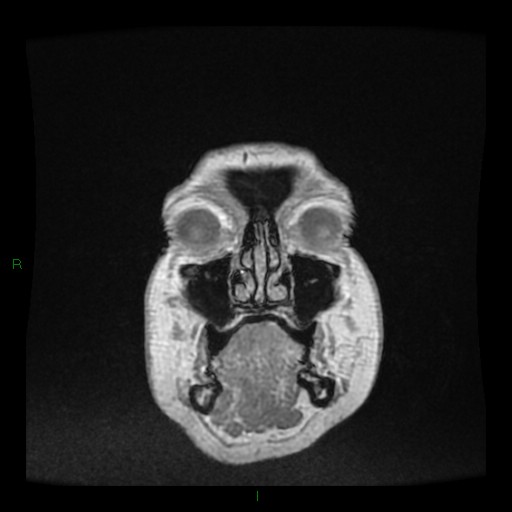 Cerebellar abscess (Radiopaedia 78135-90678 Coronal T1 C+ 3).jpg
