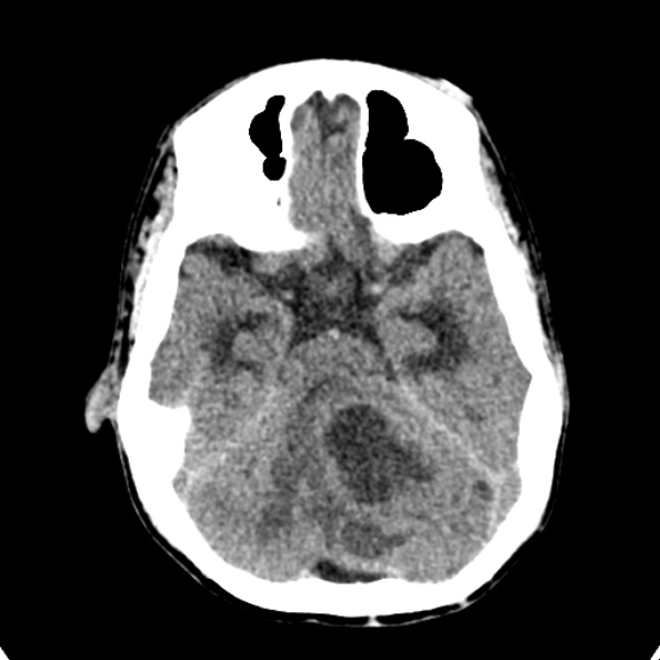 Cerebellar abscess secondary to mastoiditis (Radiopaedia 26284-26412 Axial non-contrast 50).jpg