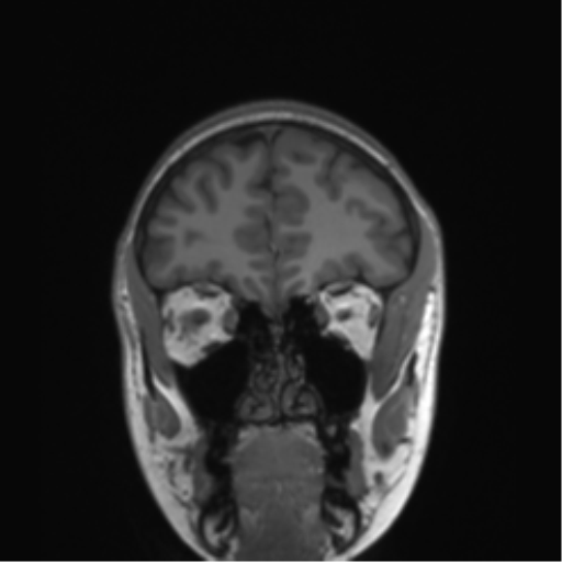 Cerebellar agenesis with hypoplastic pons (pontocerebellar hypoplasia) (Radiopaedia 57224-64138 Coronal T1 74).png