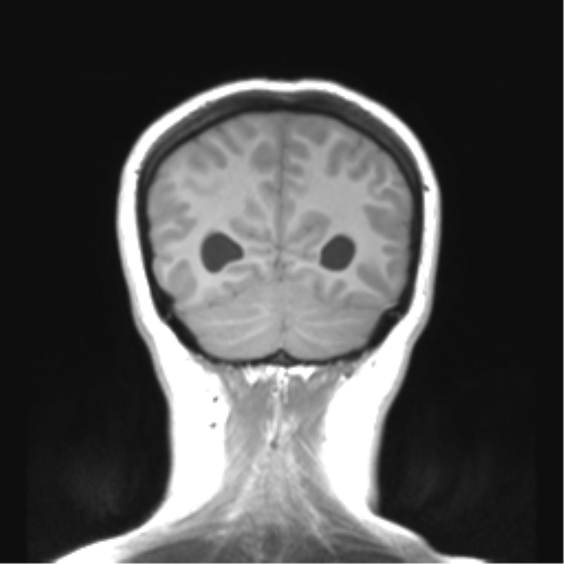 Cerebellar ependymoma complicated by post-operative subdural hematoma (Radiopaedia 83322-97736 Coronal T1 47).png