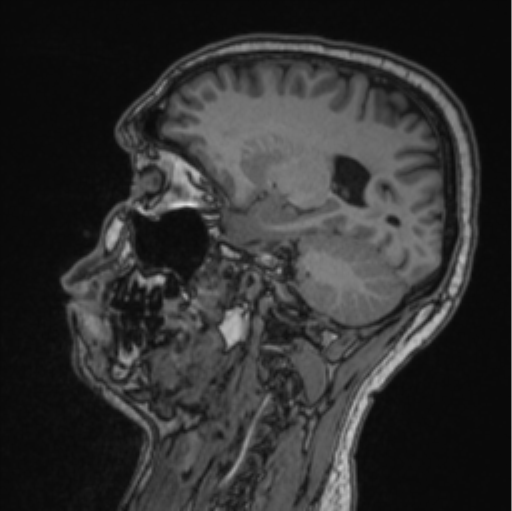 Cerebellar hemangioblastomas and pituitary adenoma (Radiopaedia 85490-101176 Sagittal T1 43).png