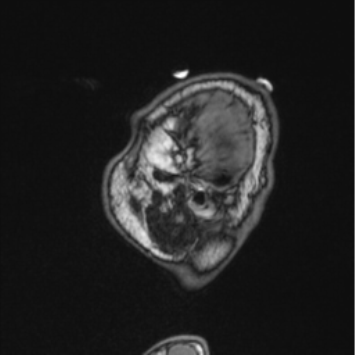 File:Cerebellar hemangioblastomas and pituitary adenoma (Radiopaedia 85490-101176 Sagittal T1 86).png
