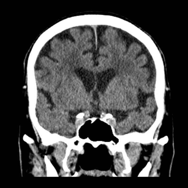 Cerebellar hemorrhage (Radiopaedia 27193-27359 Coronal non-contrast 24).jpg