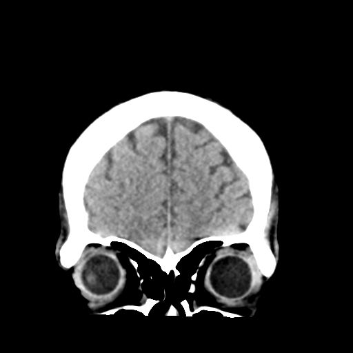 File:Cerebellar hemorrhage (Radiopaedia 37000-38669 Coronal non-contrast 8).png