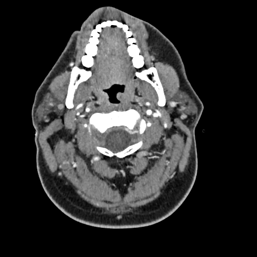Cerebellar infarct due to vertebral artery dissection with posterior fossa decompression (Radiopaedia 82779-97029 C 71).png