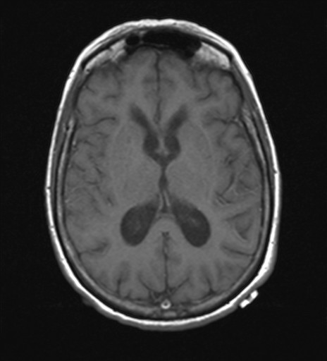 File:Cerebellar metastases (Radiopaedia 24038-24249 Axial T1 6).jpg