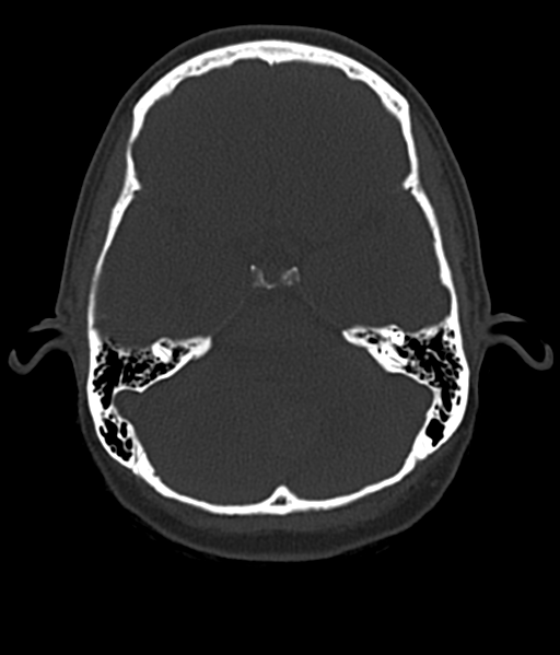 Cerebellar metastases - colorectal adenocarcinoma (Radiopaedia 40947-43652 AX Bone C- 2.0 MPR 17).png