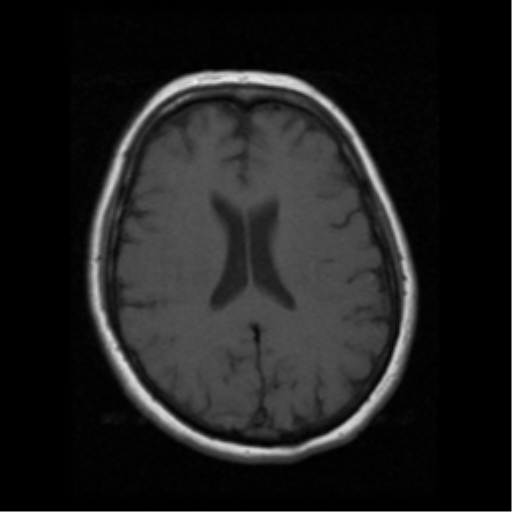 File:Cerebellar metastasis (cystic appearance) (Radiopaedia 41395-44262 Axial T1 14).png