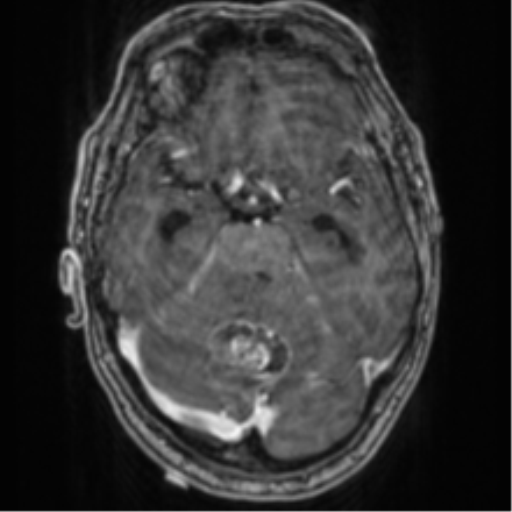 Cerebellar metastasis from lung adenocarcinoma (Radiopaedia 86690-102829 Axial T1 C+ 30).png