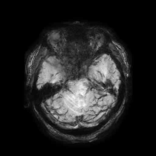 Cerebellar metastasis of pulmonary adenocarcinoma, cavernous venous malformation, and developmental venous anomaly (Radiopaedia 85827-101661 Axial SWI 48).jpg