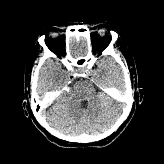 Cerebellopontine angle meningioma (Radiopaedia 53561-59592 Axial non-contrast 21).jpg