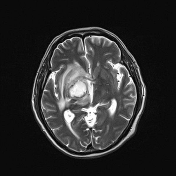 Cerebral abscess (Radiopaedia 26111-26247 Axial T2 31).jpg