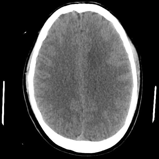 File:Cerebral abscess (Radiopaedia 29451-29919 Axial non-contrast 32).jpg