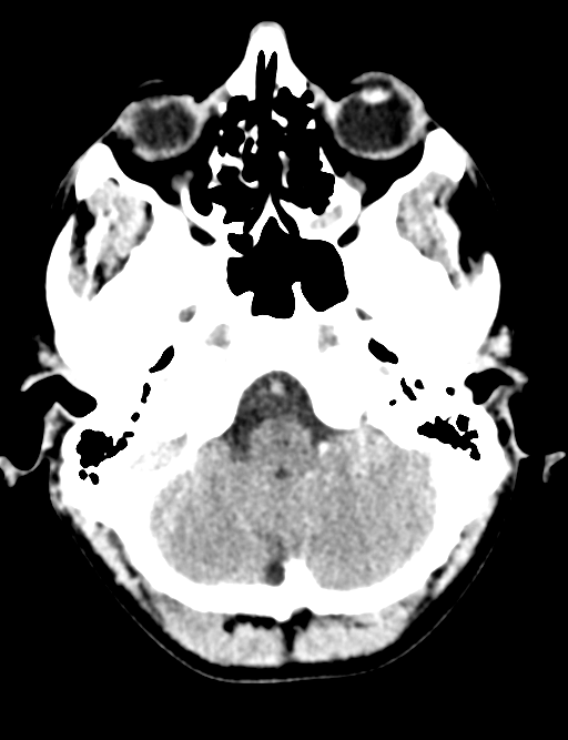 Cerebral abscess (Radiopaedia 60342-68008 Axial non-contrast 10).png