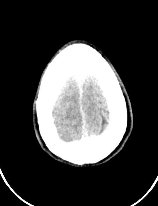 Cerebral abscess (Radiopaedia 60342-68008 Axial non-contrast 47).png